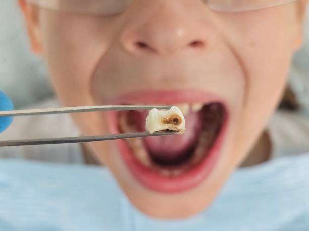 Best Pediatric Emergency Dentist in Bothell, WA