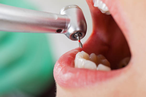 Best Emergency Tooth Extraction in Bothell, WA